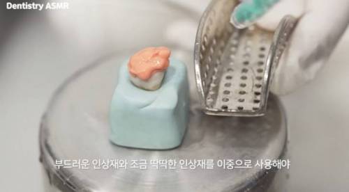 [스압] 충치 치료과정.jpgif