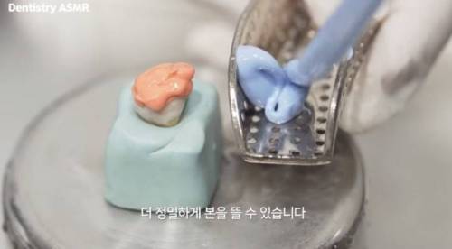 [스압] 충치 치료과정.jpgif
