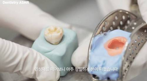 [스압] 충치 치료과정.jpgif