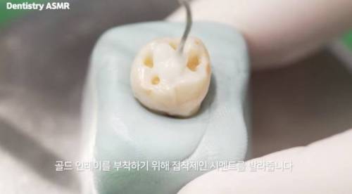 [스압] 충치 치료과정.jpgif
