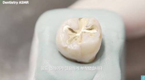 [스압] 충치 치료과정.jpgif