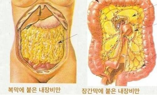 막연히 알고만있다가 실제로 보면 충격받는 내장지방 그림...jpg