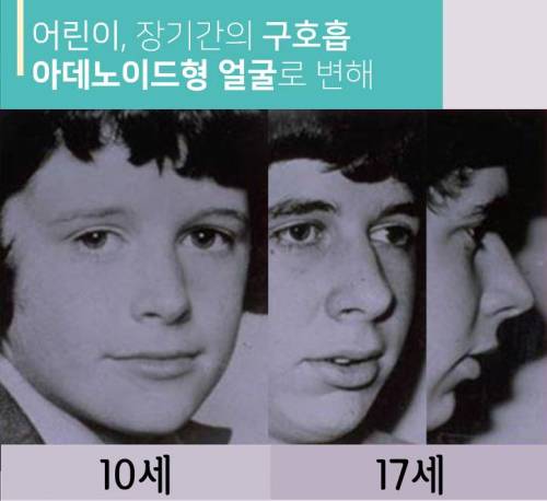 입으로 숨쉬면 안되는 이유.jpg
