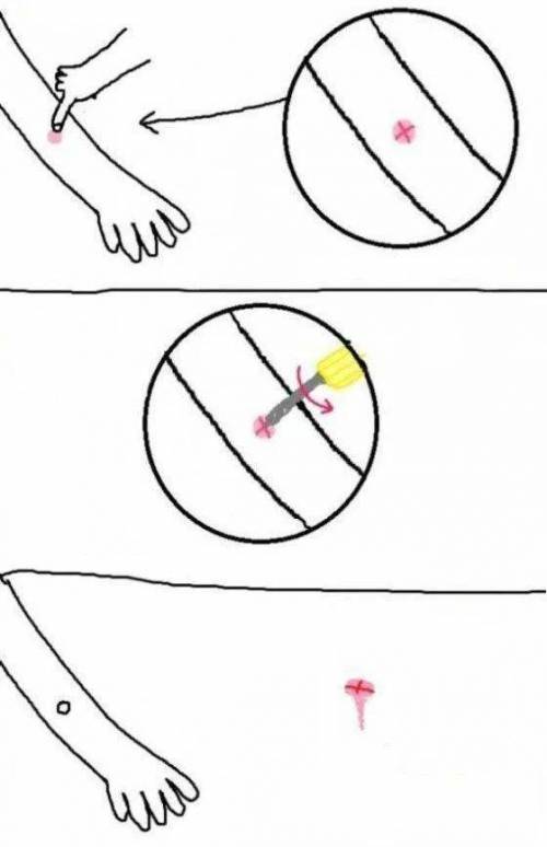 모기 물린 자리 간단한 치료법.jpg
