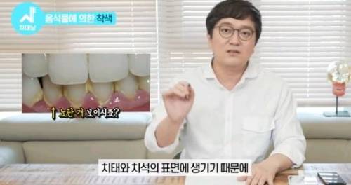 [스압] 치아 누렇게 되는 진짜이유.jpg