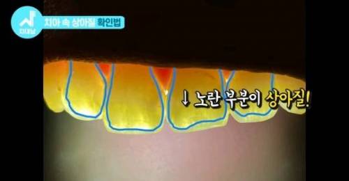 [스압] 치아 누렇게 되는 진짜이유.jpg