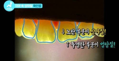 [스압] 치아 누렇게 되는 진짜이유.jpg