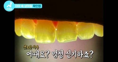 [스압] 치아 누렇게 되는 진짜이유.jpg