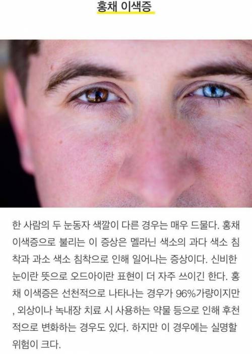 [스압] 희귀하고 독특한 신체특징 10가지.jpg