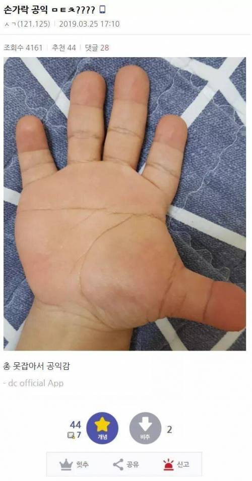 손가락 때문에 4급 판정 받은 공익