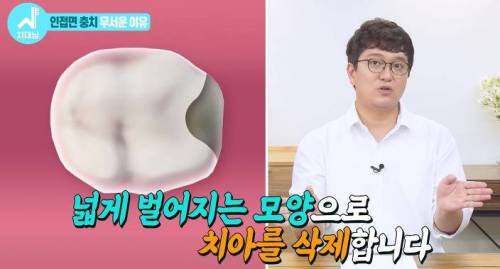 [스압] 치과의사들 "쓰읍" 소리나게 한다는 충치