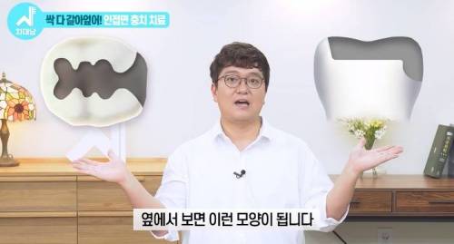 [스압] 치과의사들 "쓰읍" 소리나게 한다는 충치