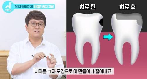 [스압] 치과의사들 "쓰읍" 소리나게 한다는 충치