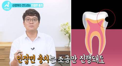 [스압] 치과의사들 "쓰읍" 소리나게 한다는 충치