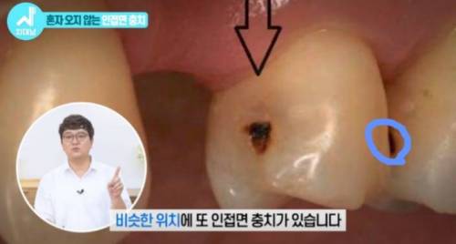 [스압] 치과의사들 "쓰읍" 소리나게 한다는 충치