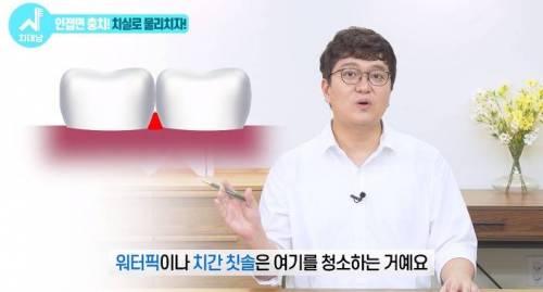 [스압] 치과의사들 "쓰읍" 소리나게 한다는 충치