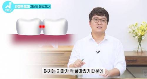 [스압] 치과의사들 "쓰읍" 소리나게 한다는 충치