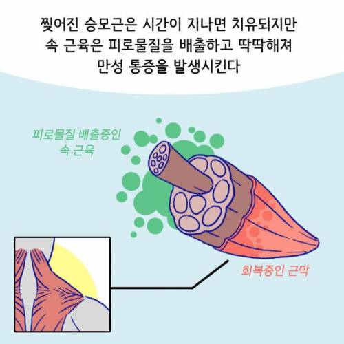 [스압] 목이나 어깨 아플 때 절대 주무르면 안 되는 부위