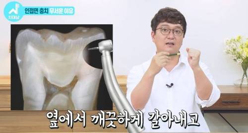 [스압] 치과의사들 "쓰읍" 소리나게 한다는 충치