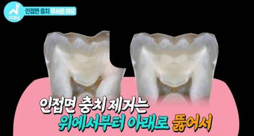 [스압] 치과의사들 "쓰읍" 소리나게 한다는 충치