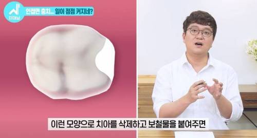 [스압] 치과의사들 "쓰읍" 소리나게 한다는 충치