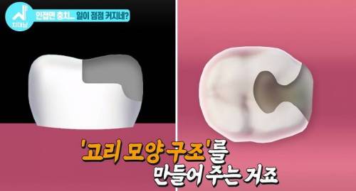 [스압] 치과의사들 "쓰읍" 소리나게 한다는 충치