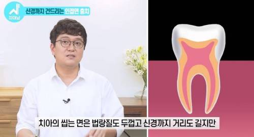 [스압] 치과의사들 "쓰읍" 소리나게 한다는 충치