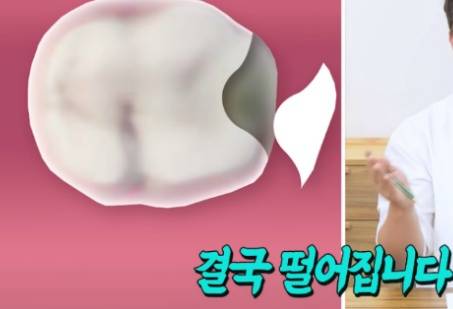 [스압] 치과의사들 "쓰읍" 소리나게 한다는 충치