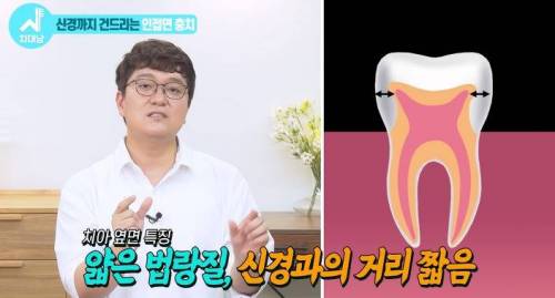 [스압] 치과의사들 "쓰읍" 소리나게 한다는 충치