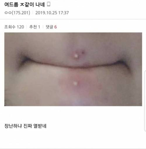 짰을 때 엄청 아픈 여드름 부위.jpg