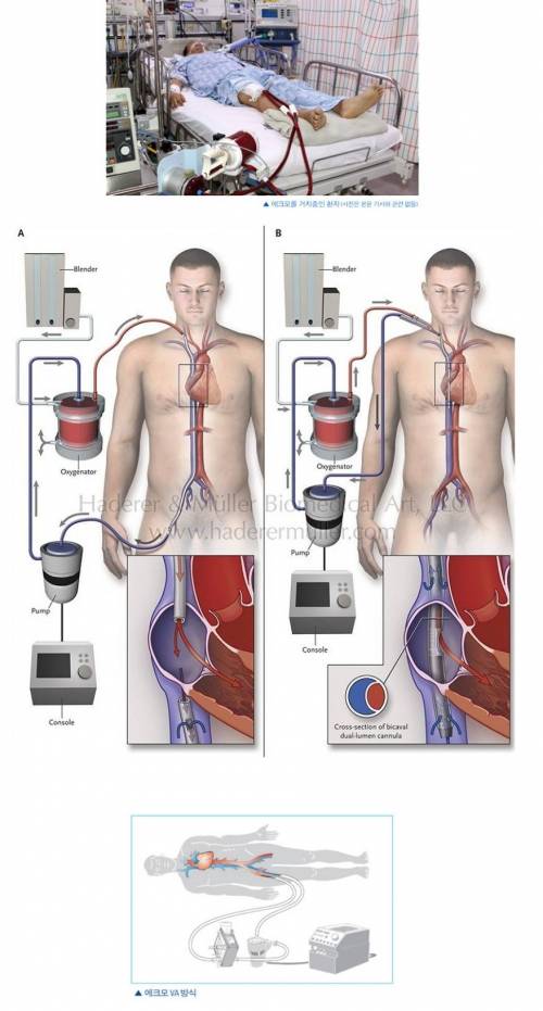 폐가 부셔져도 살려내는 21세기 궁극 치료병기 에크모