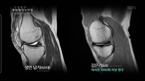 달리기 많이하면 무릎이 안좋아진다? 좋아진다?