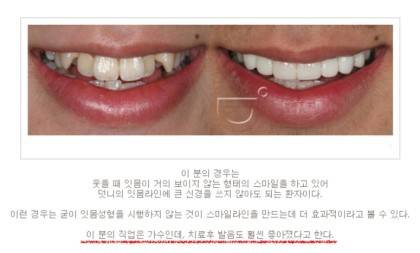 모 연예인의 치과치료 비포&에프터.jpg