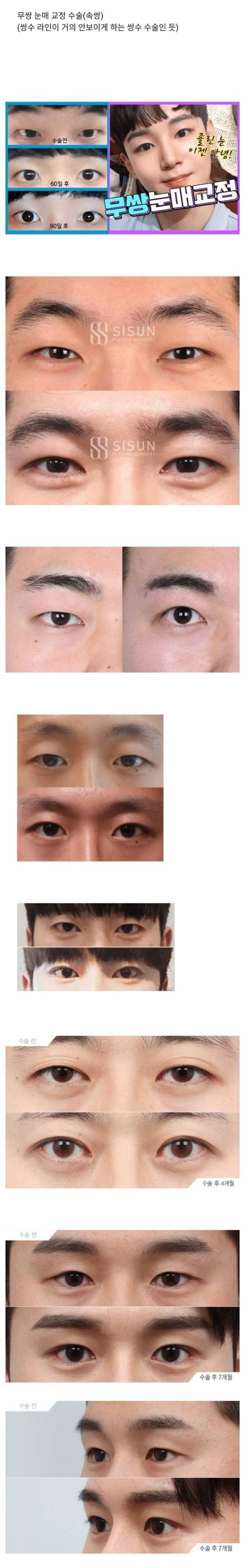 남자들 사이에서 유행이라는 성형.jpg