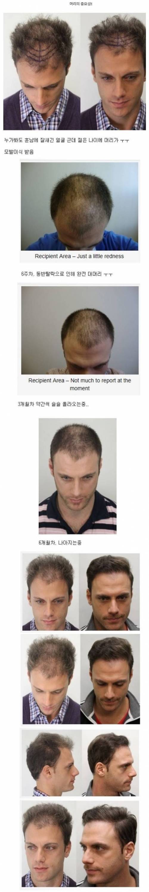 남자 모발이식수술의 중요성.jpg