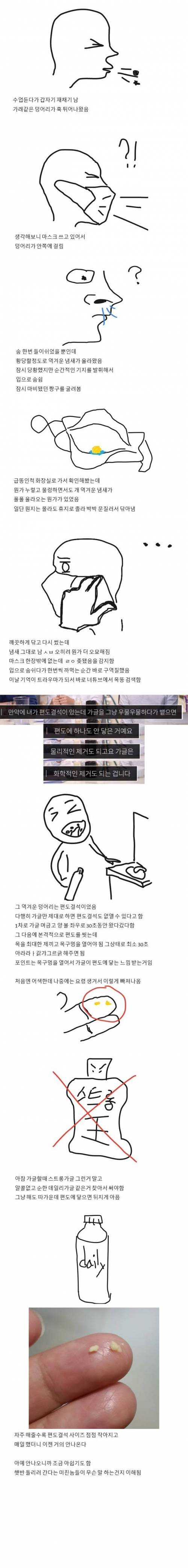 [혐] 편도결석 첫경험 썰 말해준다.jpg