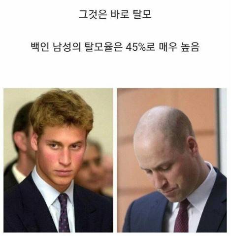 [스압] 백인 남성의 탈모율...jpg