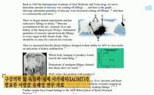 [스압] 원인모를 두통 - 아말감