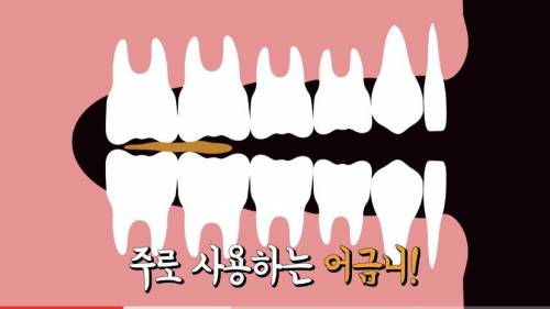 [스압] 빠진 치아 방치하면 생기는 일