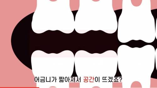 [스압] 빠진 치아 방치하면 생기는 일