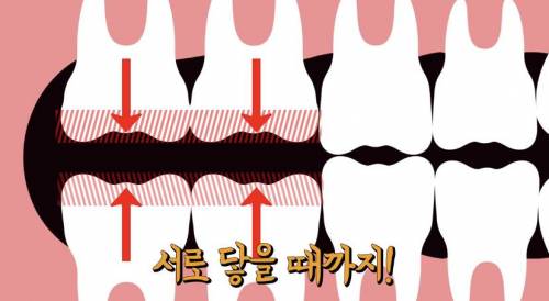 [스압] 빠진 치아 방치하면 생기는 일