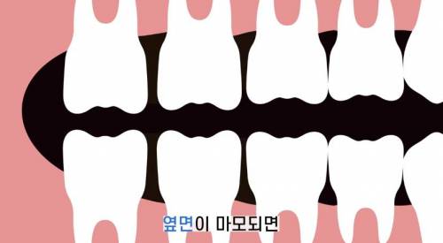 [스압] 빠진 치아 방치하면 생기는 일
