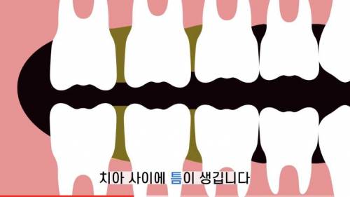[스압] 빠진 치아 방치하면 생기는 일