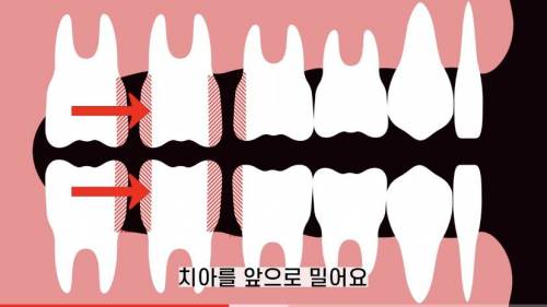 [스압] 빠진 치아 방치하면 생기는 일