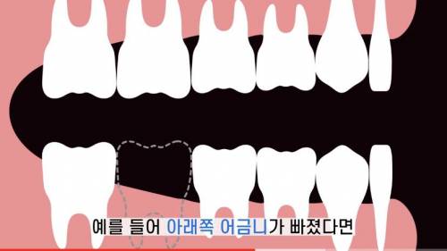 [스압] 빠진 치아 방치하면 생기는 일