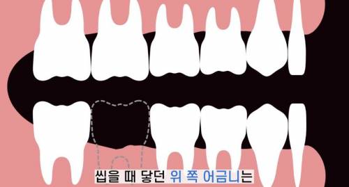 [스압] 빠진 치아 방치하면 생기는 일