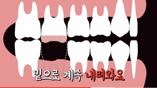 [스압] 빠진 치아 방치하면 생기는 일