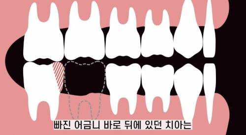 [스압] 빠진 치아 방치하면 생기는 일