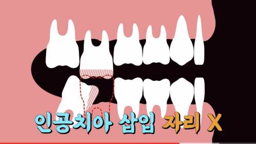 [스압] 빠진 치아 방치하면 생기는 일