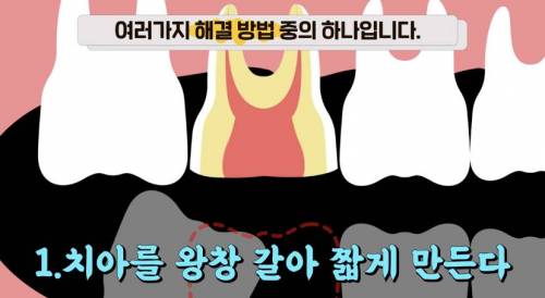[스압] 빠진 치아 방치하면 생기는 일